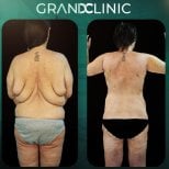 До и после круговой подтяжки тела в Grand Clinic, видимый результат улучшения спины