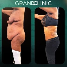 Результаты до и после круговой подтяжки тела в Grand Clinic – улучшение контуров