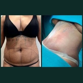 Before and after tummy tuck results at Grand Clinic – visible abdominal contour improvement