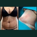 Before and after tummy tuck results at Grand Clinic – visible abdominal contour improvement