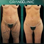 Результати ліпосакції до і після в Grand Clinic, помітне покращення контурів тіла