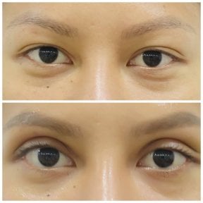 Before and after upper eyelid surgery results at Somchai Clinic, improved eyelid contour