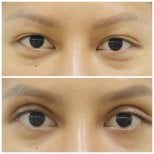 Before and after upper eyelid surgery results at Somchai Clinic, improved eyelid contour