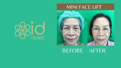 before-after photo mini-fejslifting