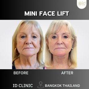 before-after photo mini-fejslifting