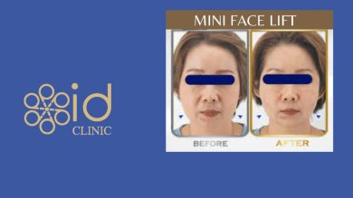 before-after photo mini-fejslifting