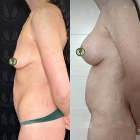 before-after photo abdominoplasty