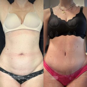 before-after photo abdominoplasty