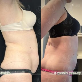 before-after photo abdominoplasty
