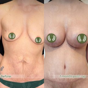 before-after photo breast-augmentation