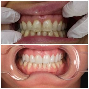 before-after photo rekonstrukciya-zubov-s-ispolzovaniem-kompozitov-bonding