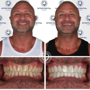 before-after photo emax-veneers