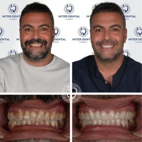 before-after photo emax-veneers