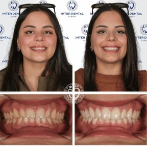 before-after photo emax-veneers