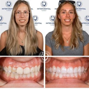 before-after photo emax-veneers