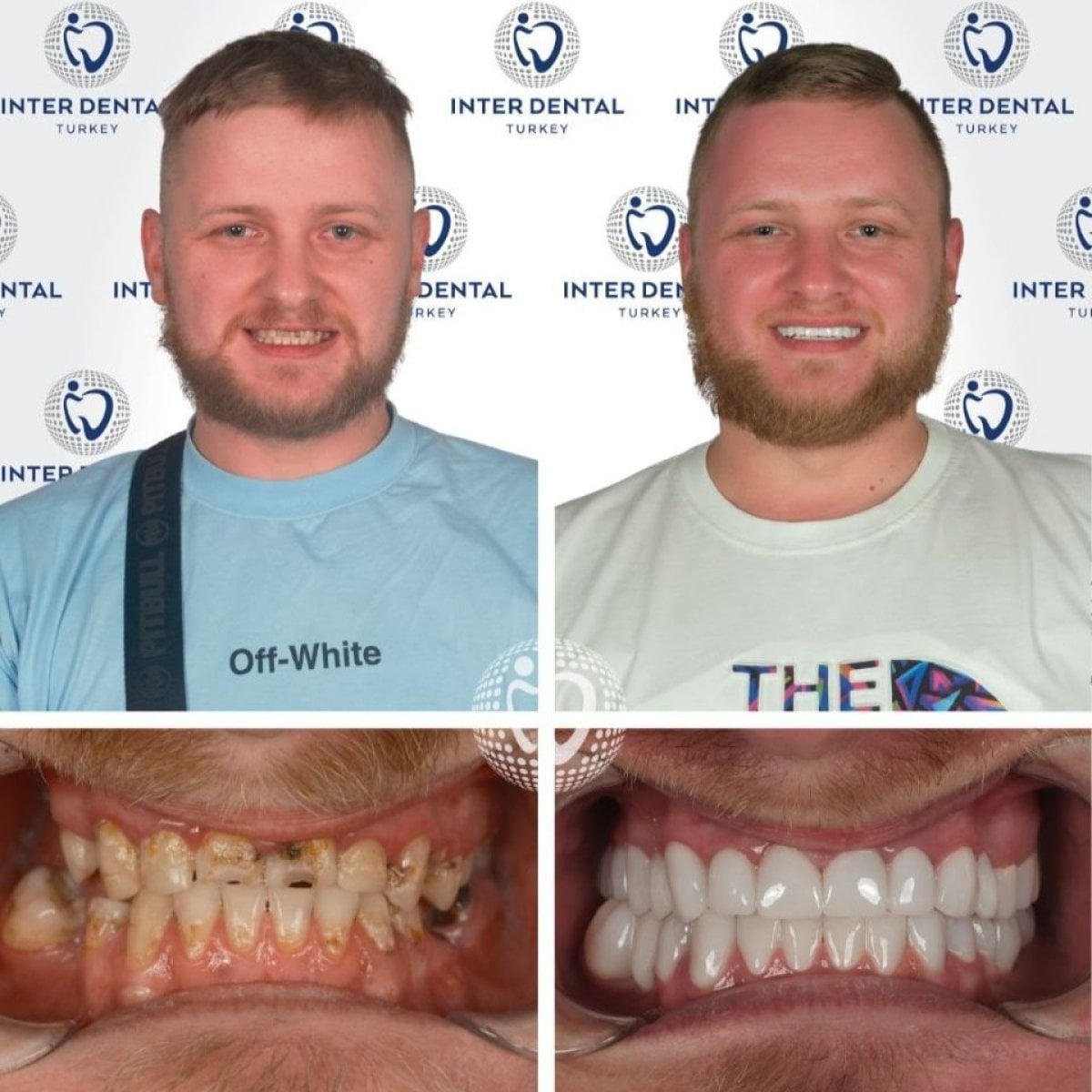 قبل وبعد تركيب تيجان الأسنان في Inter Dental Turkey – ابتسامة وأسنان مستعادة