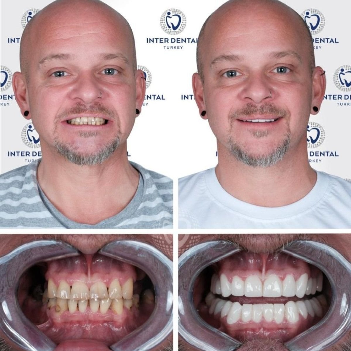 نتائج قبل وبعد تركيب تيجان الأسنان في Inter Dental Turkey، ابتسامة محسنة