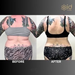 before-after photo vaser-liposakcia