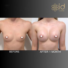 before-after photo uvelicenie-grudi