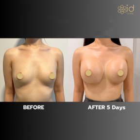 before-after photo uvelicenie-grudi