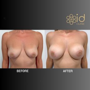 before-after photo uvelicenie-grudi