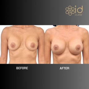 before-after photo uvelicenie-grudi
