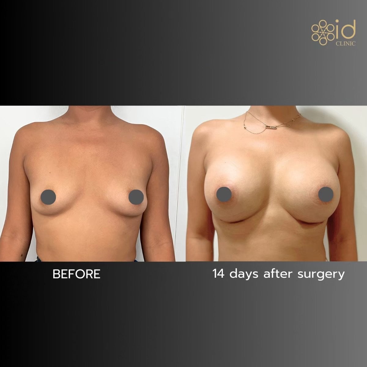 نتائج شد الثدي مع حشوات دائرية في ID Clinic Bangkok، تحسن ملحوظ في الشكل