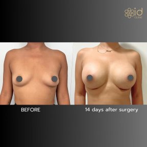 before-after photo podtazka-grudi-s-uveliceniem-kruglymi-implantami