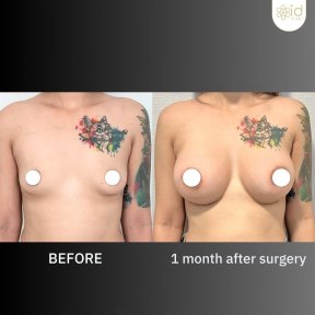 before-after photo podtazka-grudi-s-uveliceniem-kruglymi-implantami