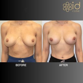 before-after photo podtazka-grudi-s-uveliceniem-kruglymi-implantami