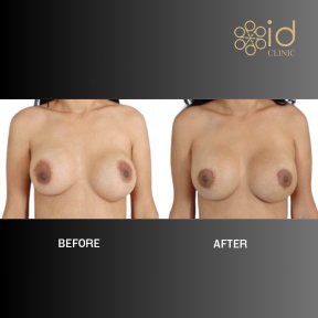 before-after photo podtazka-grudi-s-uveliceniem-kruglymi-implantami