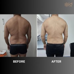 before-after photo liposakciya