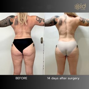 before-after photo liposakciya