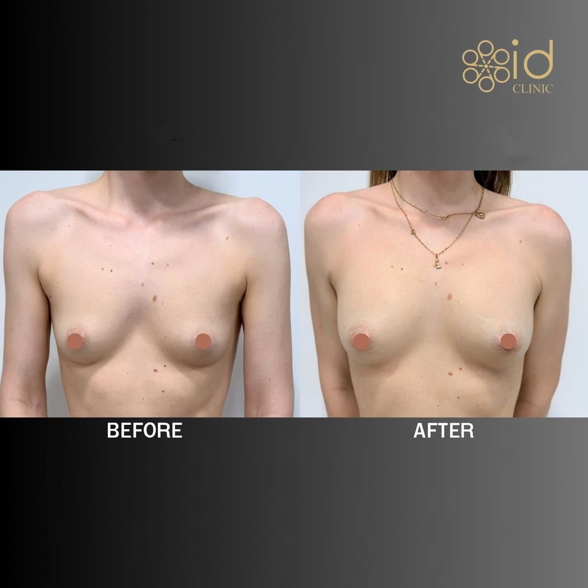 Resultados antes y después de aumento de senos con transferencia de grasa en ID Clinic Bangkok