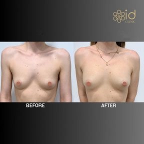 before-after photo lipofiling-molocnyh-zelez