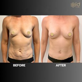 before-after photo lipofiling-molocnyh-zelez