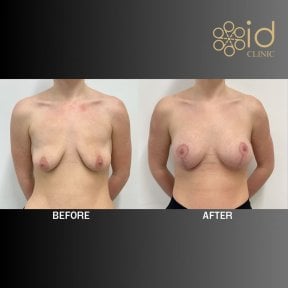 before-after photo uvelicenie-grudi