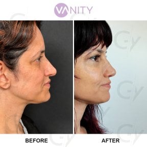Результати до і після підтяжки обличчя у Vanity Cosmetic Surgery Hospital, омолодження