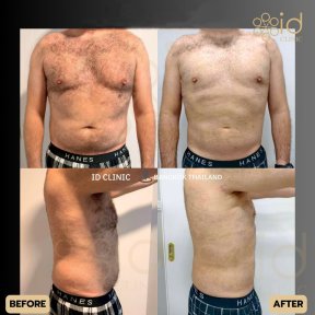 before-after photo liposakciya