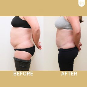 before-after photo abdominoplastika-i-liposakcia