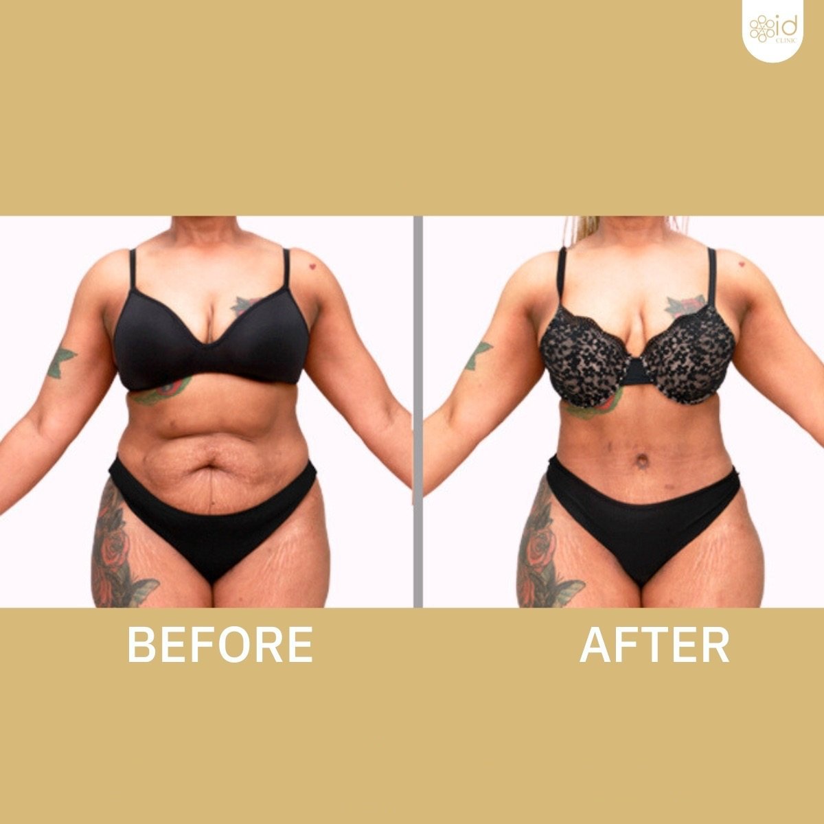 Resultados de abdominoplastia y liposucción antes y después en ID Clinic Bangkok, mejor contorno