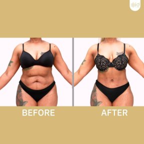 before-after photo abdominoplastika-i-liposakcia