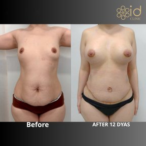 before-after photo abdominoplastika-i-liposakcia