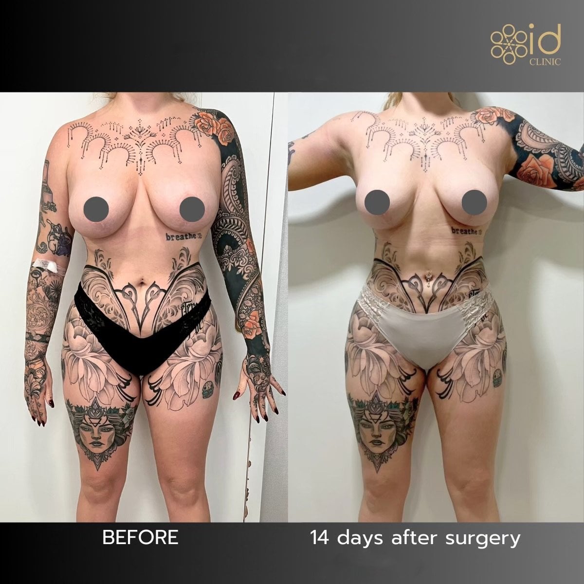 Resultados de liposucción abdominal antes y después en ID Clinic Bangkok, cambio visible de cintura