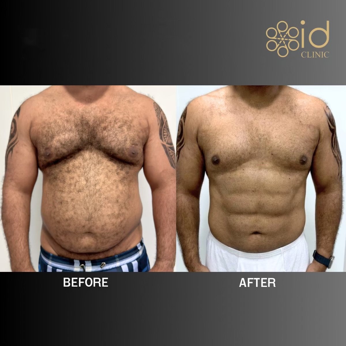 Resultados de abdominal etching antes y después en ID Clinic Bangkok, abdomen marcado