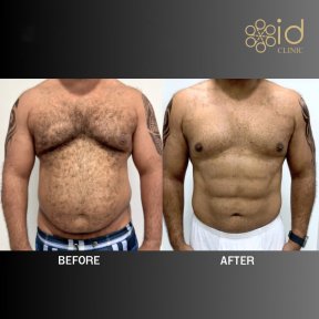 before-after photo abdominalnoe-travlenie
