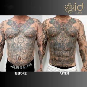 before-after photo abdominalnoe-travlenie