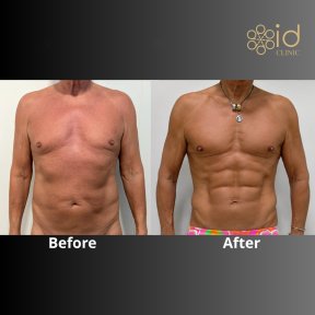 before-after photo abdominalnoe-travlenie