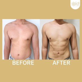 before-after photo abdominalnoe-travlenie