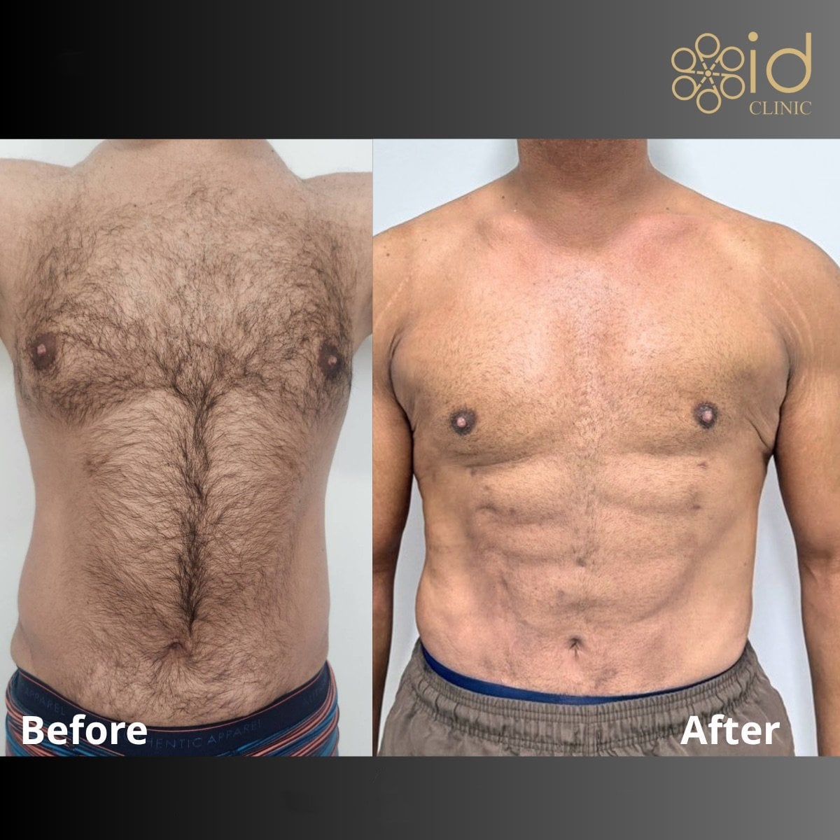 نتائج نحت البطن قبل وبعد في ID Clinic Bangkok، عضلات بطن محددة